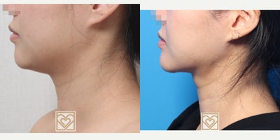 Chin Liposuction before and after photo