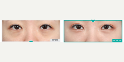 Eyelid Surgery before and after photo