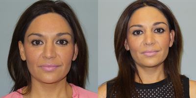 Rhinoplasty before and after photo