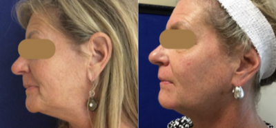 Sculptra before and after photo