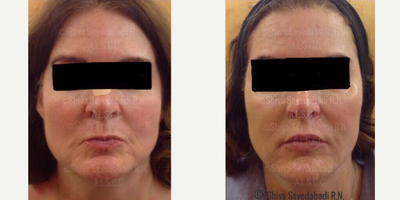 Thread Lift before and after photo