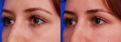 Belotero before and after photo
