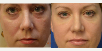 Eyelid Surgery before and after photo
