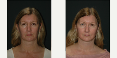 Facelift before and after photo