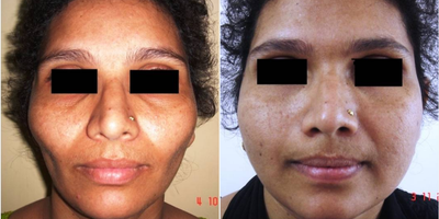 Facial Fat Transfer before and after photo