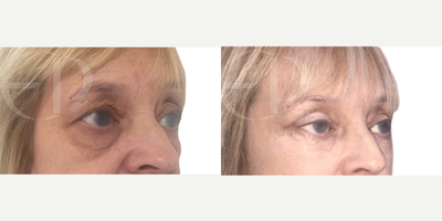 Eyelid Surgery before and after photo
