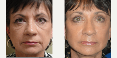 Facelift before and after photo