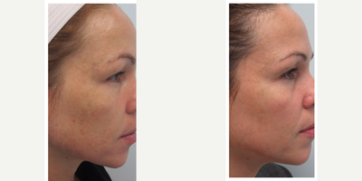 IPL before and after photo
