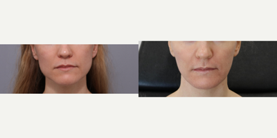 Botox before and after photo