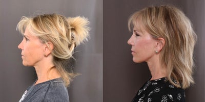 Brow Lift before and after photo