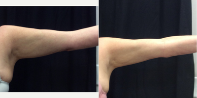 CoolSculpting before and after photo