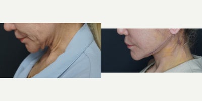 Deep Plane Facelift before and after photo