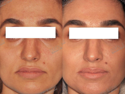 Dermal Fillers before and after photo