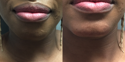 Chin Filler before and after photo