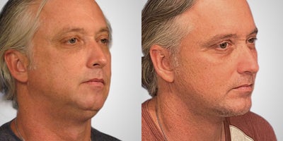 Chin Implant before and after photo