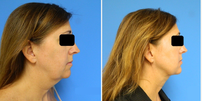 PrecisionTx before and after photo