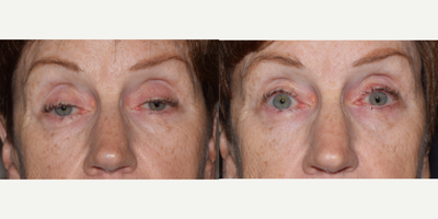Ptosis Surgery before and after photo