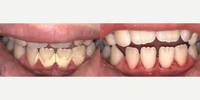 Smile Makeover before and after photo