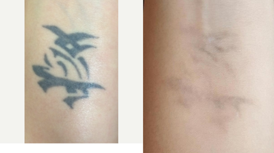 Tattoo Removal before and after photo