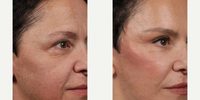 Eyelid Surgery before and after photo