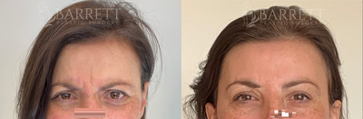 Botox before and after photo
