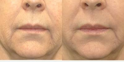 CO2 Laser before and after photo
