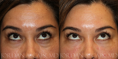 Dermal Fillers before and after photo