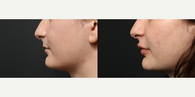 Lip Fillers before and after photo