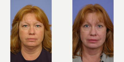 Neck Lift before and after photo