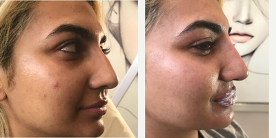 Nonsurgical Nose Job before and after photo