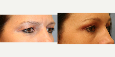 Brow Lift before and after photo