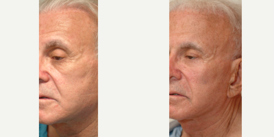 Cheek Lift before and after photo