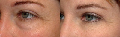 Eyelid Surgery before and after photo