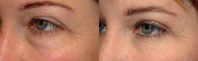 Eyelid Surgery before and after photo