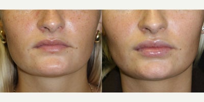 Lip Fillers before and after photo