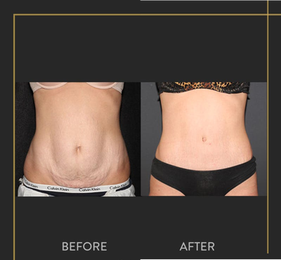 Tummy Tuck before and after photo