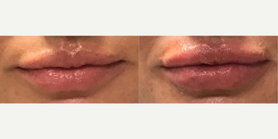 Lip Fillers before and after photo