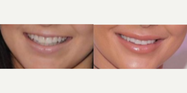 Lip Fillers before and after photo