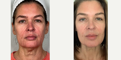 Nonsurgical Facelift before and after photo