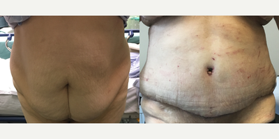 Tummy Tuck before and after photo