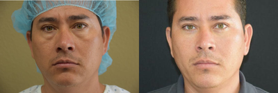 Eyelid Surgery before and after photo