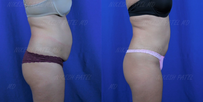 Laser Liposuction before and after photo