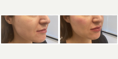 Lip Fillers before and after photo