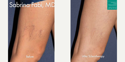Sclerotherapy before and after photo