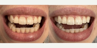 Tooth Repair before and after photo
