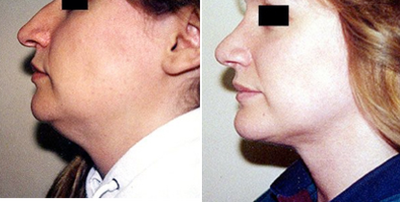 Chin Implant before and after photo