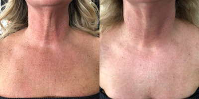 IPL before and after photo