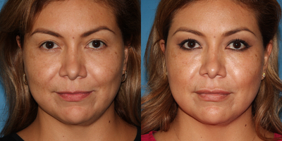 Juvederm before and after photo