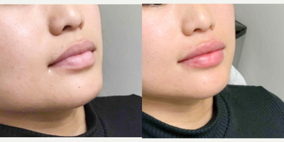 Lip Fillers before and after photo