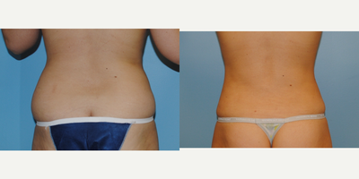 Liposuction before and after photo